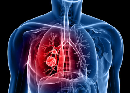 COPD Information